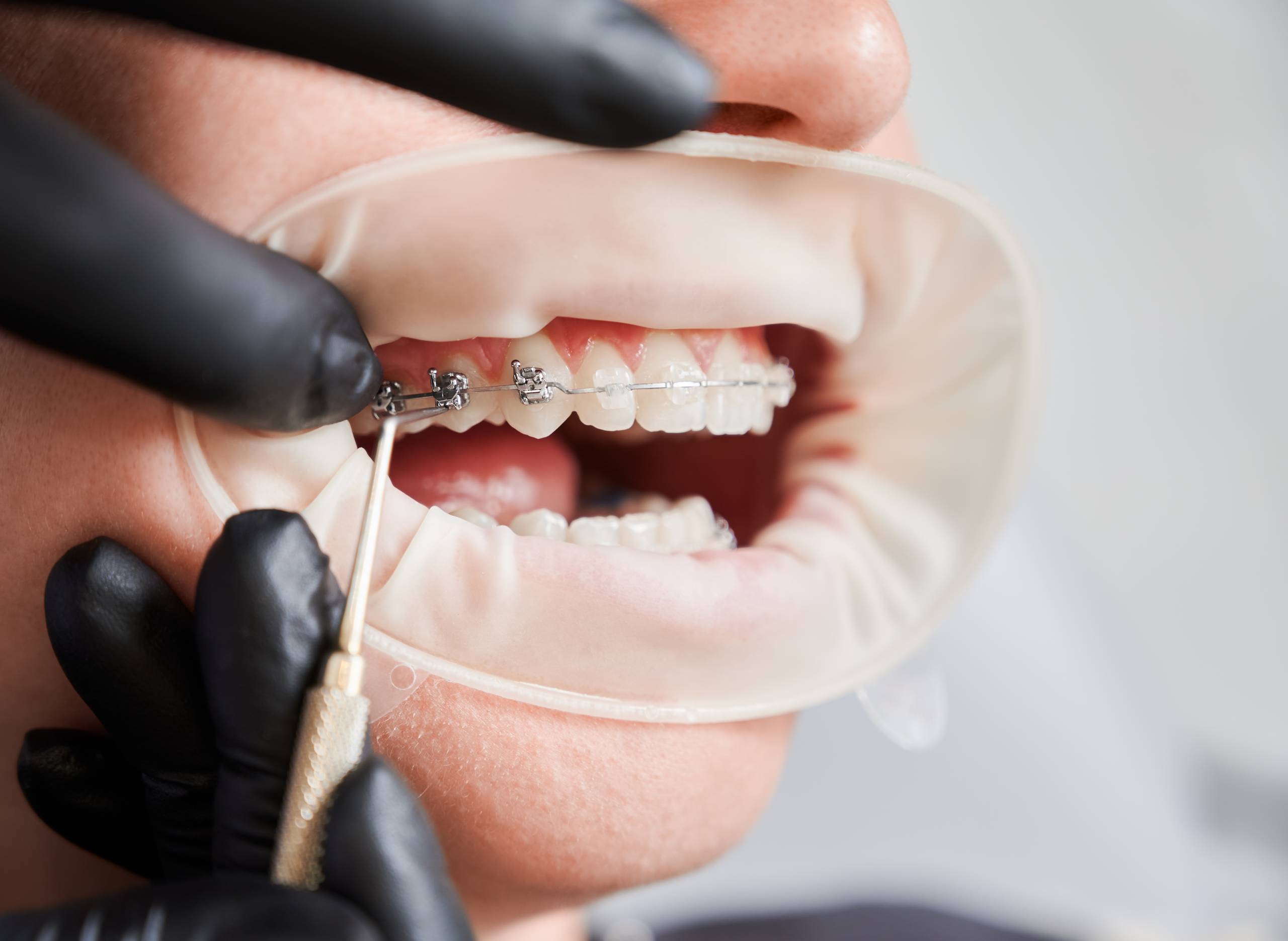 What Are Teeth Braces and Why Do You Need Them?
