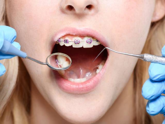 Do Braces Fix Buck Teeth?