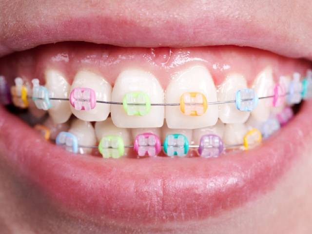 How Safe Is It To Do Dental Braces Yourself?